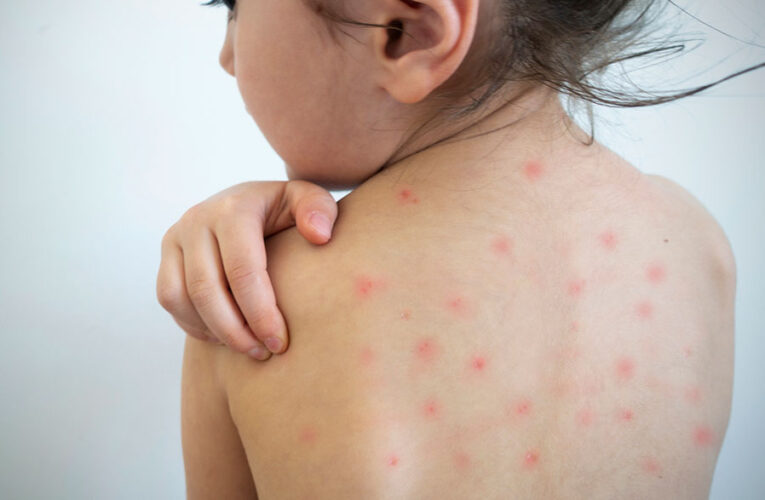 Nuevo León registra 60 casos de sarampión